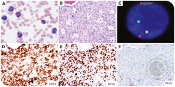 Acute myeloid leukemia with BCL6 and KMT2A dual rearrangements