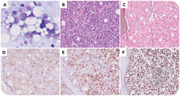 Acute erythroid leukemia or acute myeloid leukemia with mutated TP53? The battle of phenotype versus genotype