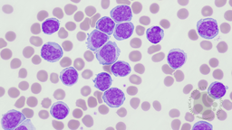 CD5 negative leukemic mantle cell lymphoma with prolymphocyte morphology