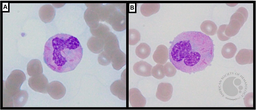 Neutrophil Auer Rods