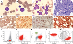 Blastoid variant of double-hit lymphoma masquerading as acute lymphoblastic leukemia