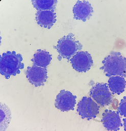 CSF involvement by metastatic carcinoma from breast