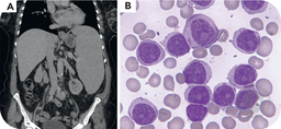 Prolymphocytic progression of splenic marginal zone lymphoma