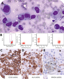 ALK anaplastic large cell lymphoma expressing CD33 and myeloid nuclear differentiation antigen