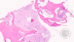 Bone Marrow Granuloma
