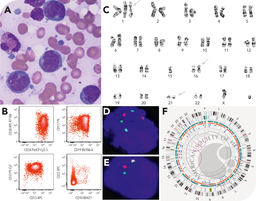 Acute myeloid leukemia with RUNX1::CBFA2T3 fusion