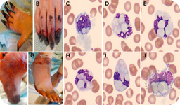 Heat-insoluble cryoglobulin in peripheral blood
