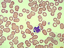 Howel-jolly like bodies in Neutrophils. 2
