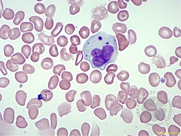 Pseudo-chediak higashi granules in monocyte