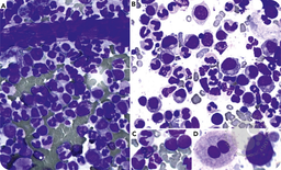 Atypical chronic myeloid leukemia: from cytology to molecular characterization