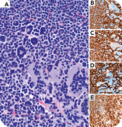 Warthin-Finkeldey cells seen in a setting other than measles: chronic lymphocytic leukemia/small lymphocytic lymphoma