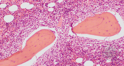 Bone marrow trephine H&E (10 x hpf)
