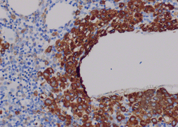 Bone marrow trephine myeloperoxidase stain (20 x hpf)