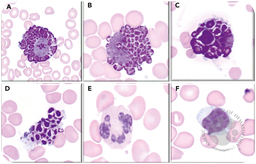 Giant cytoplasmic inclusions (Alder-Reilly bodies) in Hurler syndrome (mucopolysaccharidosis type 1H)
