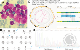 Chromoplexy and FNDC3B::RARB fusion: deciphering a rare case of PML::RARA-negative APL