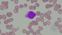 Auer rod in AML
