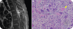 Paraspinal mass and lower extremity weakness in a patient with thalassemia