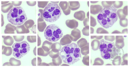 Botryoid neutrophils - cocaine abuse