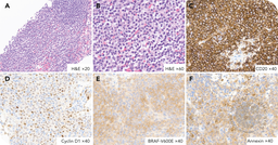 A rare case of nodal hairy cell leukemia exhibiting characteristic morphological and immunohistochemical features