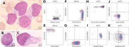 Early T-precursor acute lymphoblastic leukemia with mature plasmacytoid dendritic cell proliferation