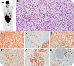 When lymphoma mimics adenocarcinoma: signet ring morphology in follicular lymphoma