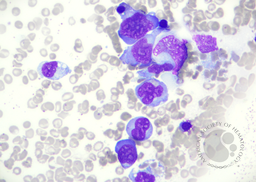 EBV-related Lymphoproliferative Disorder in Bone Marrow, Figure 1A