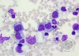 EBV-related Lymphoproliferative Disorder in Bone Trephine, Figure 1B