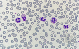 Neutrophil hyper-segmentation 1