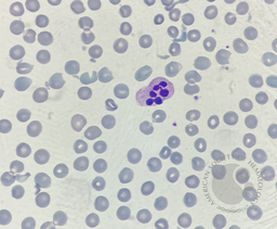 Neutrophil hyper-segmentation 2