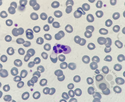Neutrophil hyper-segmentation 3