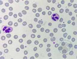 Neutrophil hyper-segmentation 4