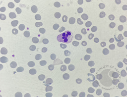 Neutrophil hyper-segmentation 5