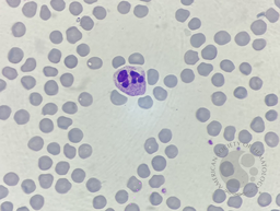 Neutrophil hyper-segmentation 6