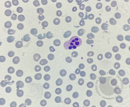 Neutrophil hyper-segmentation 7