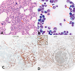 Myelodysplastic neoplasm with biallelic TP53 inactivation in a patient with plasma cell myeloma after cytotoxic therapy