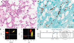 Clonal γδ T-cell proliferation associated with Babesia infection: a rare and challenging diagnostic pitfall