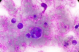 Hemophagocytosis (Bone marrow aspirate)