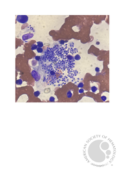 Histoplasmosis in Bone Marrow aspirate