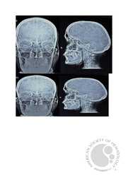 Extensive lytic lesions in A Case of MM