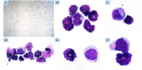 CSF myeloid blast crisis with frank basophilia in patient of CML, on therapy. 1