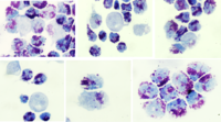 CSF myeloid blast crisis with frank basophilia in patient of CML, on therapy. 2