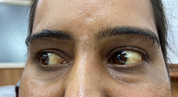 Eltrombopag induced yellowish of Sclera in Severe Aplastic Anemia patient