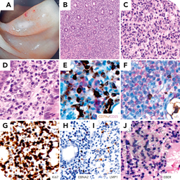 Adult T-cell leukemia/lymphoma coexistent with immune dysregulation–associated EBV lymphoproliferative disorder