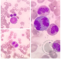 Abnormal Mitosis in Myelodysplastic Syndrome (MDS)