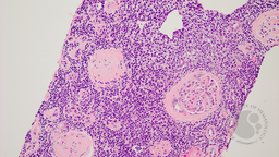 Kidney, H&E stain showing interstitial lymphocytes