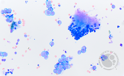 Vitreous Fluid with Detached Retinal Cells and Large B-cell Lymphoma
