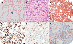 Classic hairy cell leukemia and concomitant smoldering myeloma