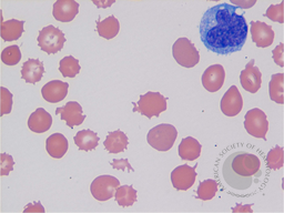 Spur Cell Anemia 1