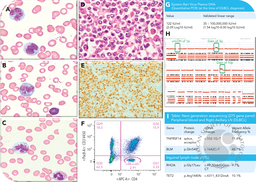 Unveiling the enigma: circulating flowerlike large B-lymphoma cells in the context of angioimmunoblastic T-cell lymphoma
