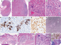 Primary myelofibrosis involving lymph nodes with the same mutational profile in bone marrow